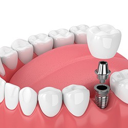 3D graphic of single dental implant