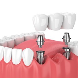 3D graphic of dental bridge