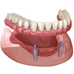 3D graphic of implant dentures 