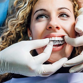 dentist putting clear aligner on patient